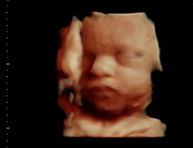 3D ultrasound image at 31 weeks